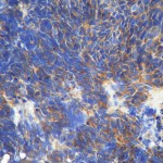 Metástasis de carcinoma de célula grande sin signos de diferenciación.