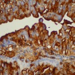 Infiltración de mucosa duodenal por adenocarcinoma mal diferenciado.