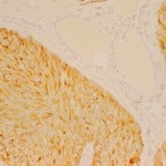 Carcinoma medular de tiroides