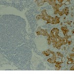 Ganglio linfático. Metástasis de carcinoma de próstata