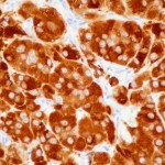Tumor de células de Leydig ovárico