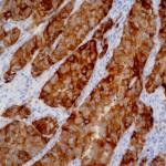 Carcinoma pulmonar indiferenciado de célula grande. (Mutación L858R del exón 21 de EGFR)