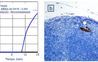 Detección de micrometástasis en ganglio centinela mediante OSNA (a) e inmunohistoquímica (PANK, 200x) (b).