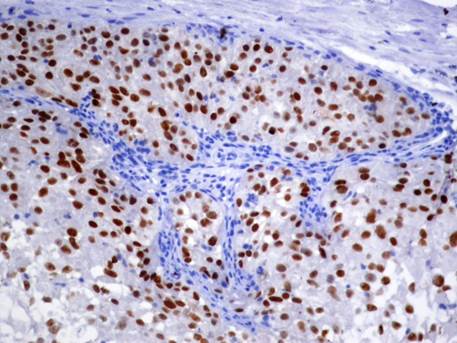 Metástasis de carcinoma renal de células claras. Positividad nuclear de PAX8 en células neoplásicas