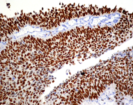 Carcinoma urotelial GATA-3 positivo.