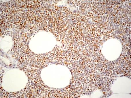Linfoma B difuso de célula grande. Positividad de c-MYC en más del 70% de núcleos
